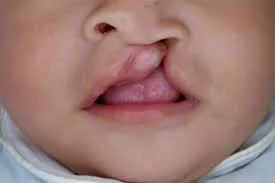 labios leporino