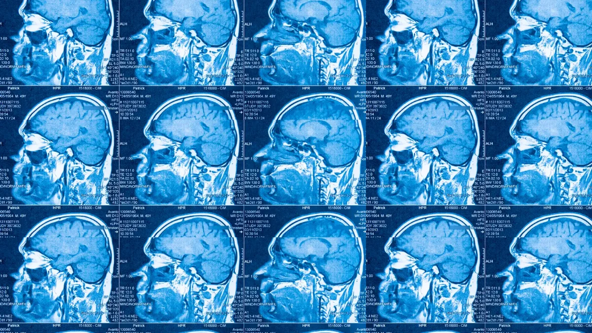 Los científicos usaron resonancias magnéticas funcionales (RMF) en el cerebro para identificar los subtipos de autismo.