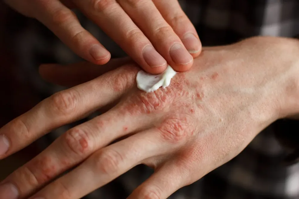 Psoriasis-- anmat