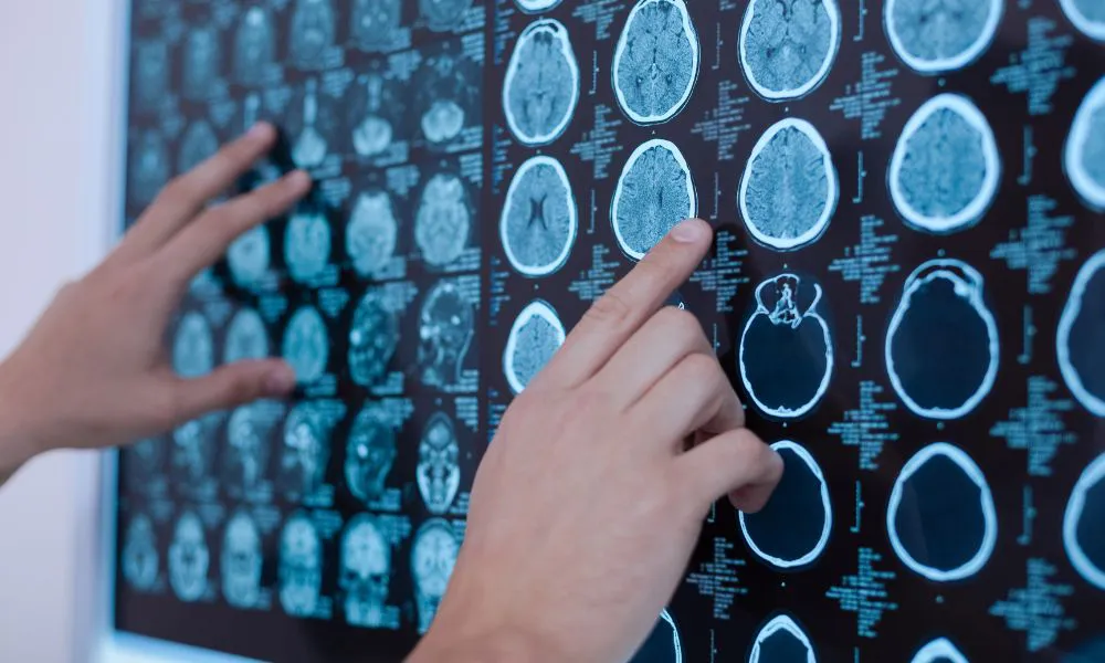 Tomografía cerebral