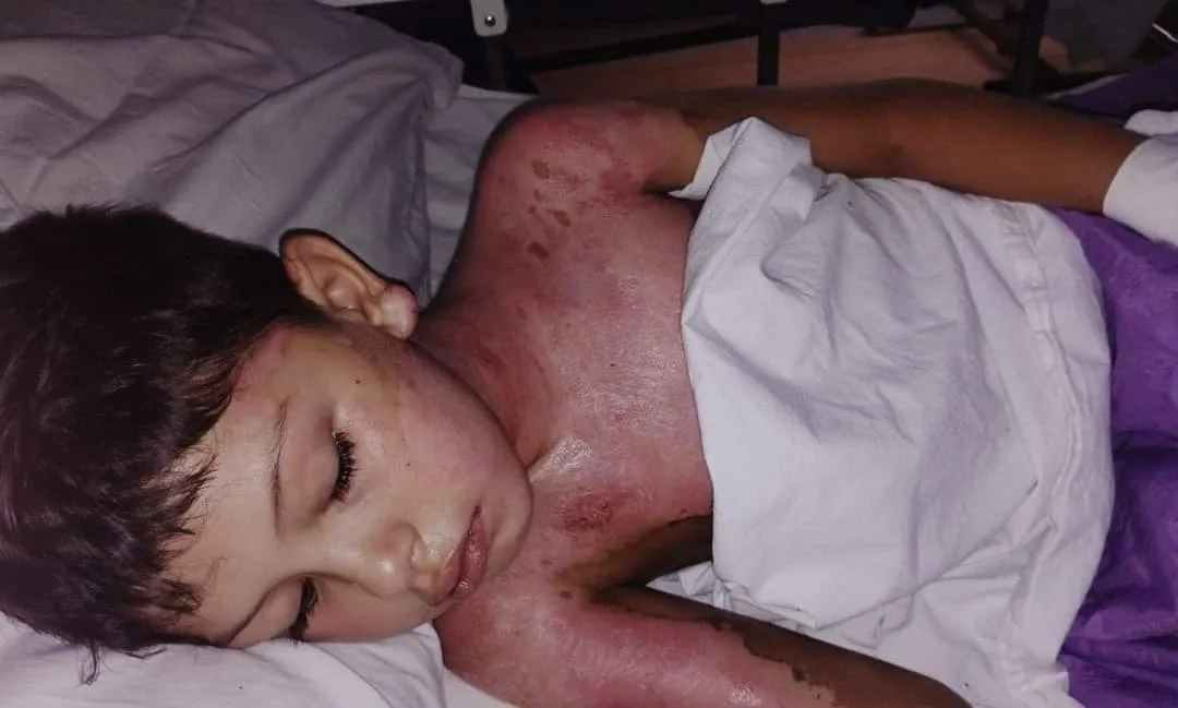 SOLIDARIDAD: AYUDEMOS A MATEO, UN NENE DE 8 AÑOS QUE SUFRIÓ QUEMADURAS
