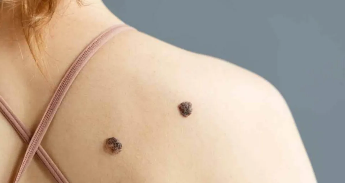 melanoma