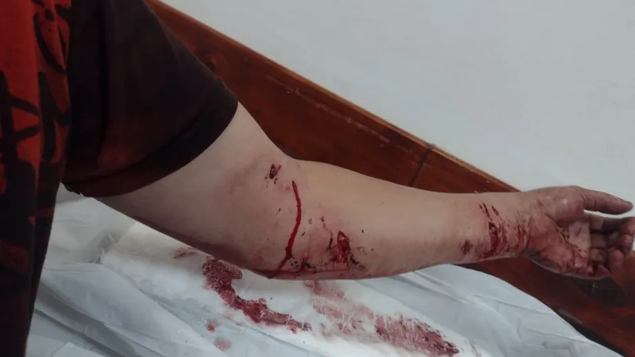 Brazo herido por los perros pitbull