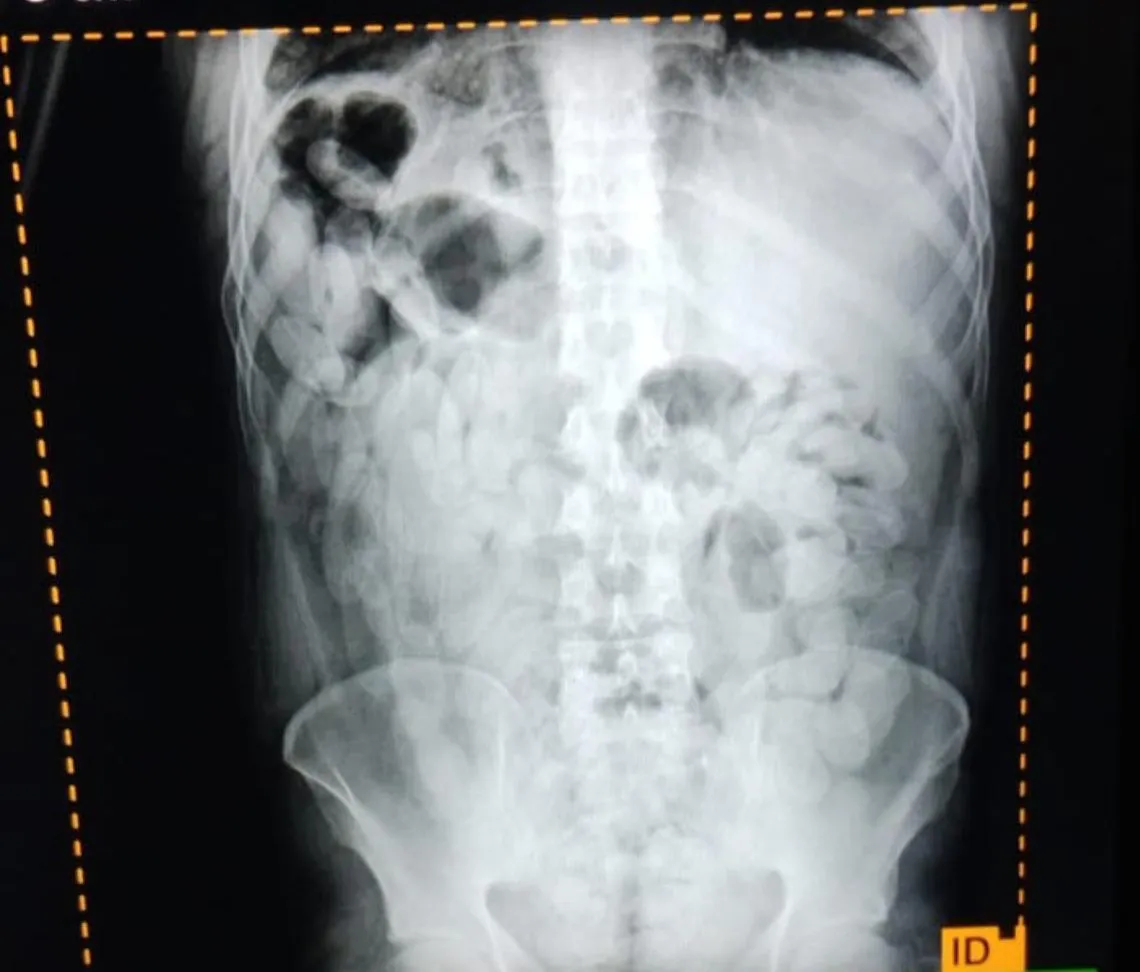 Transportaban más de dos kilos de cocaína en el estómago