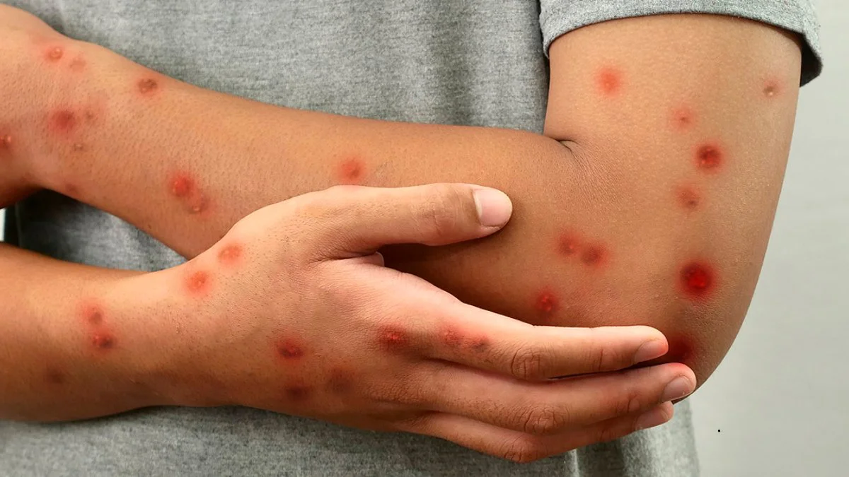 Mpox