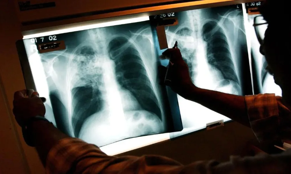 Tuberculosis