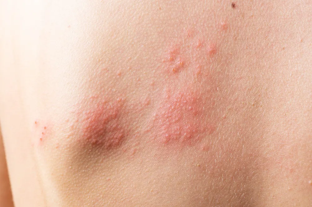 Dermatitis atópica
