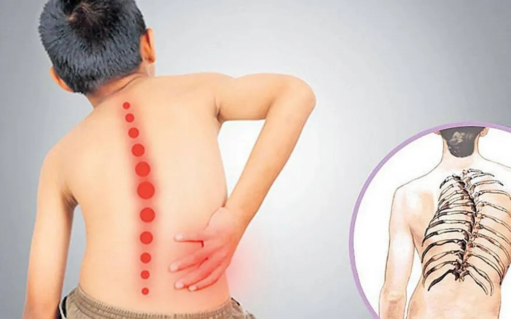 Atrofia Muscular Espinal (Foto: i-Farma)