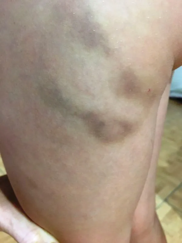 MORETONES-NINO-ATACADO-1