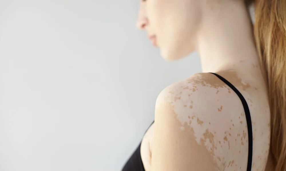 Vitiligo Foto ilustrativa fuente freepik