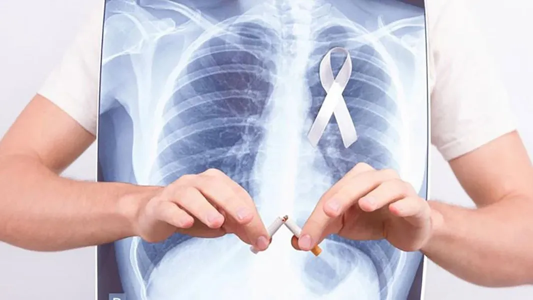Cáncer de pulmón