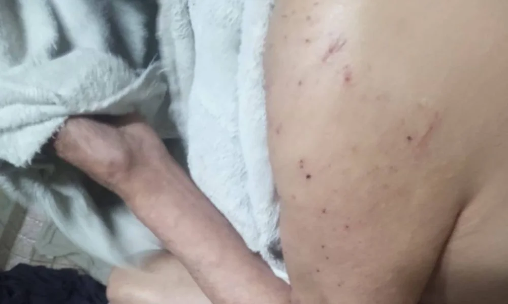 adulto mayor picado por chinches