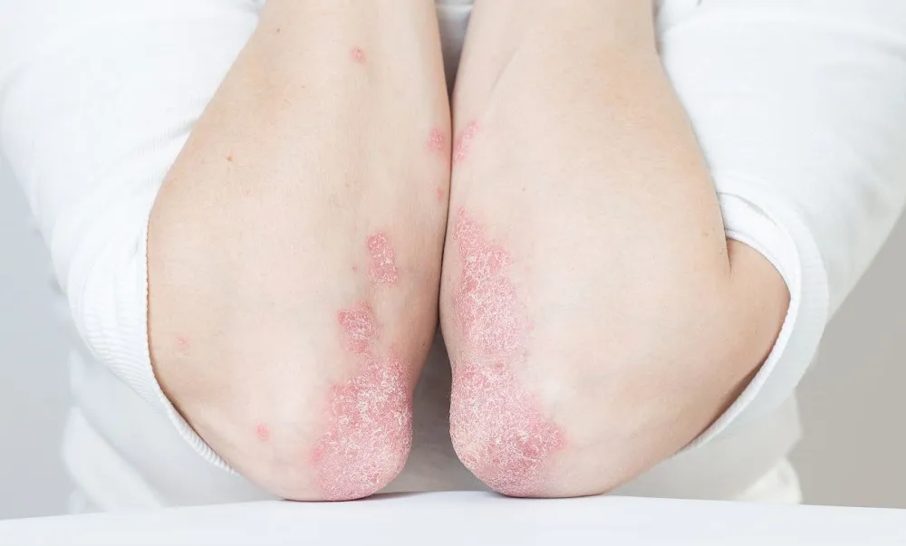 Psoriasis