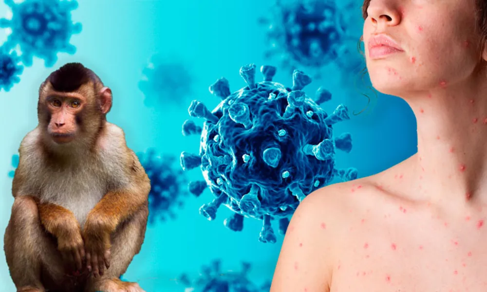 Primer caso sospechoso de viruela del mono en Chubut