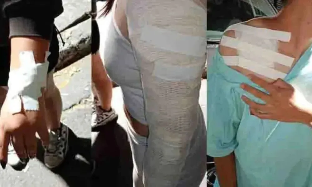 clientes quemados en boliche de Bariloche