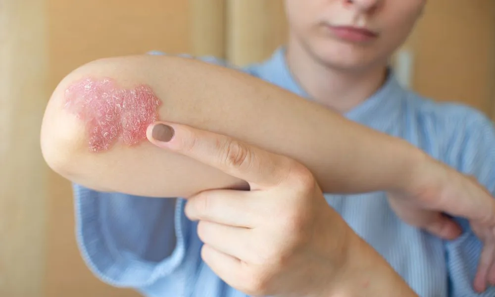 Psoriasis (Foto: marypoly)