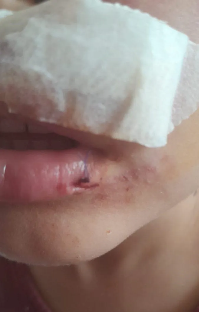 Heridas del niño en el rostro