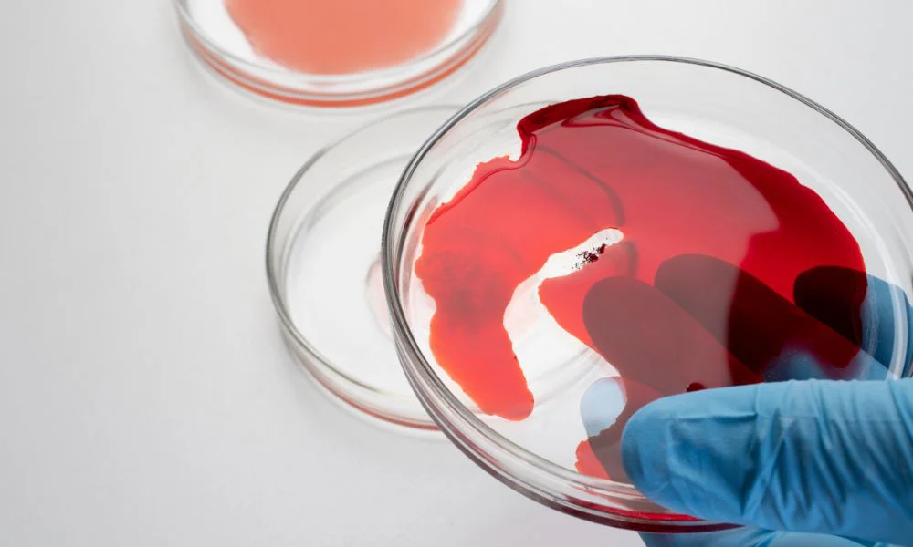 Cáncer de sangre. Foto Magnific